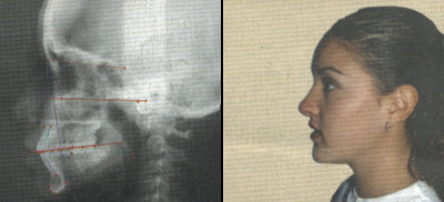 Radiografias laterales simples